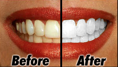 Teeth Whitening