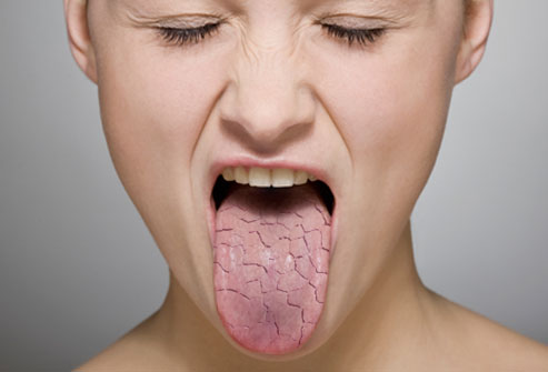 dry mouth
