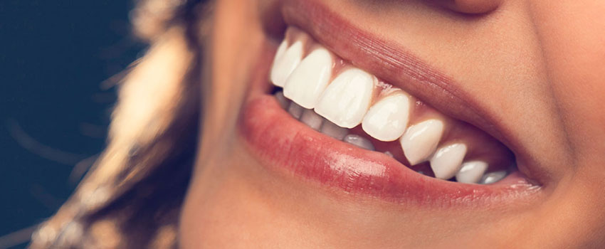 veneers