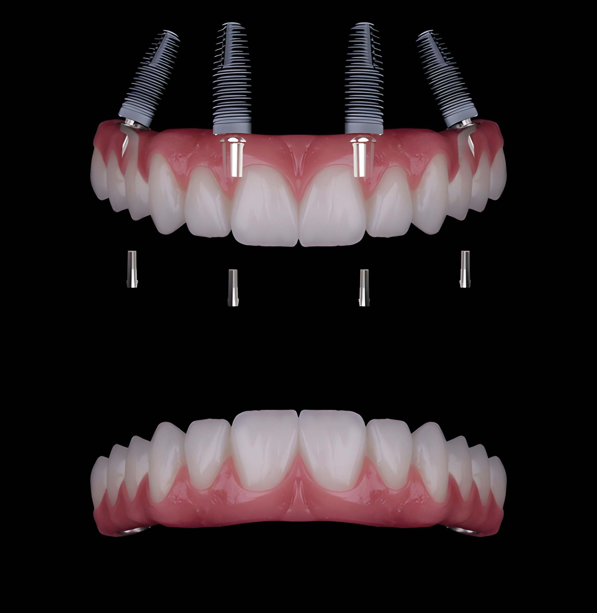 all-on-4 dental implants in midtown toronto
